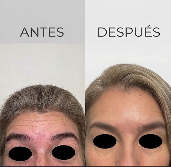 Resultado Toxina Botulínica — Antes y Después