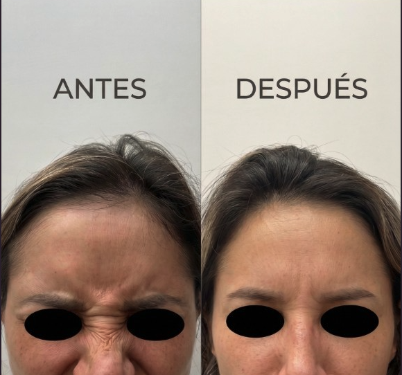 Resultado Toxina Botulínica — Antes y Después